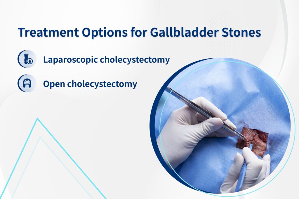 Treatment Options for Gallbladder Stones