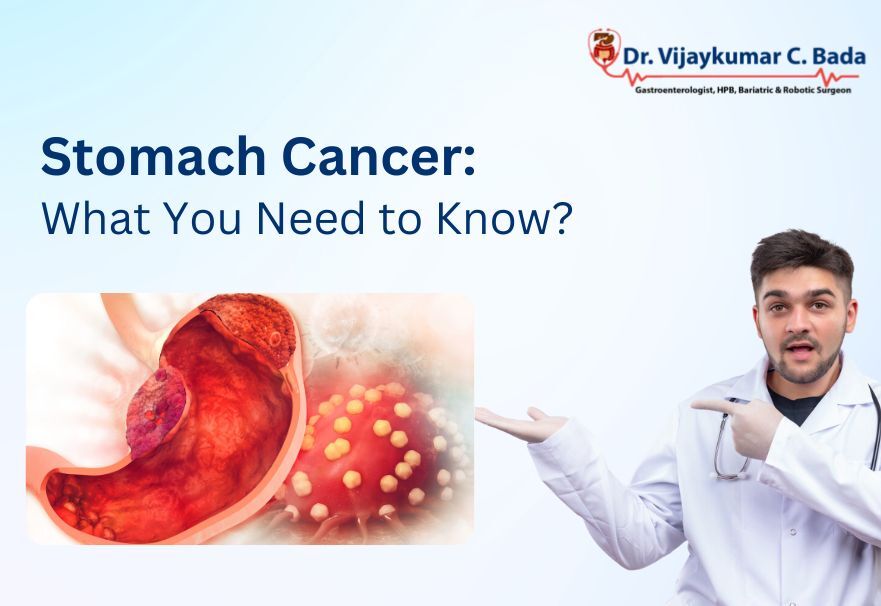 stomach cancer what you need to know?