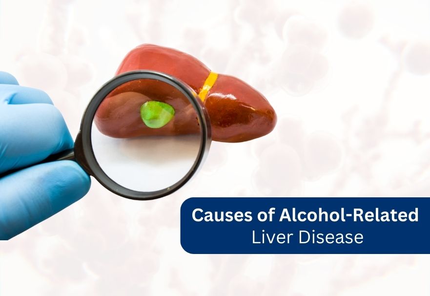 causes of Alcohol related liver disease