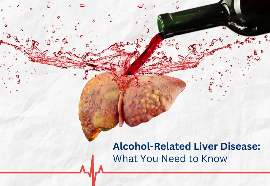 Alcohol related liver disease : what you need to know ?